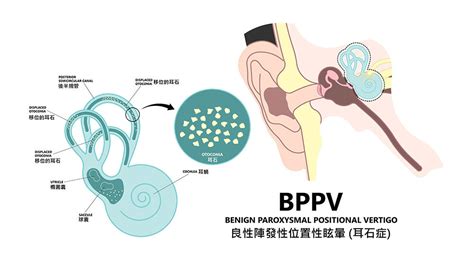 耳石復位法|經常頭暈可能和耳石症 (BPPV) 有關! 了解症狀、成因。